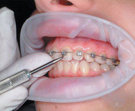 Branqueamento dentário